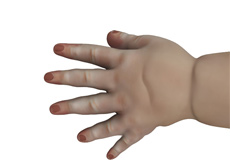 Congenital Hand