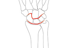 Carpal Instability