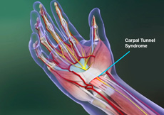 Thumb Arthritis New York City | Wrist Sprain Tri-State Area