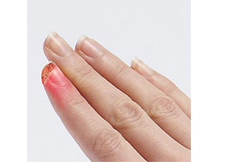 Fingertip Injuries