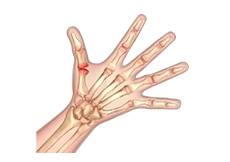 Thumb Arthritis