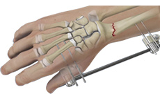 Wrist Fracture Fixation